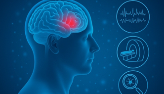 Parkinson hastalığı tanı belirtileri görseli